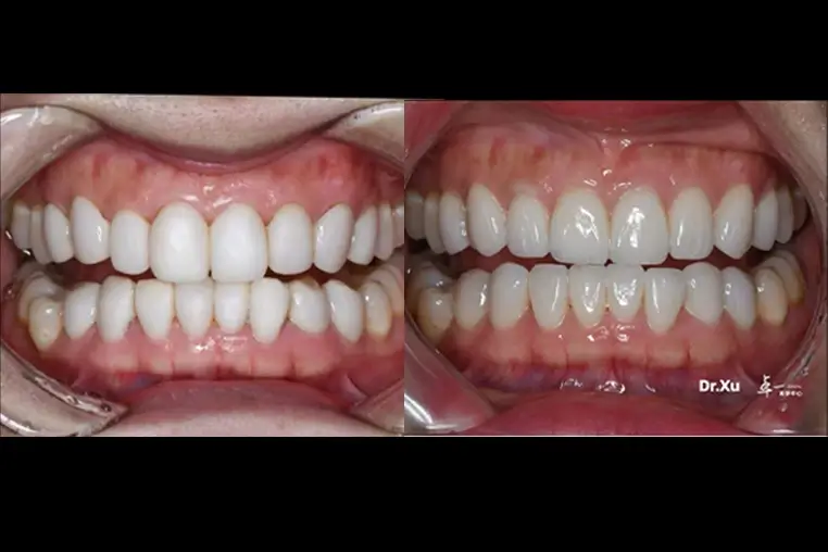 Porcelain Veneers