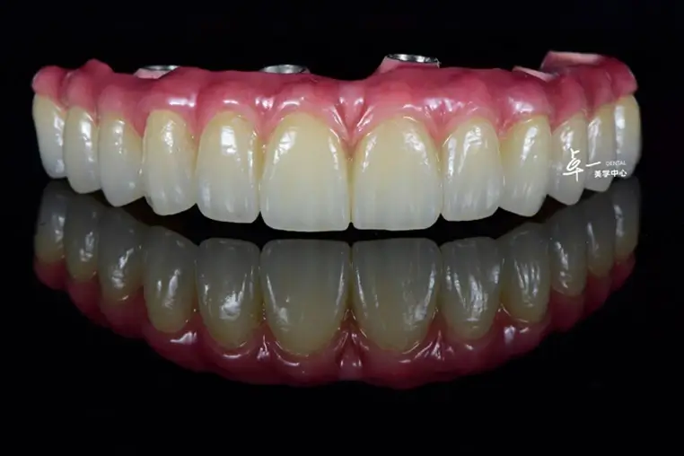 Fixed dental prostheses