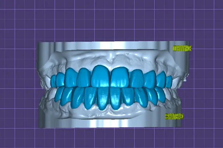 Digital dental scanning