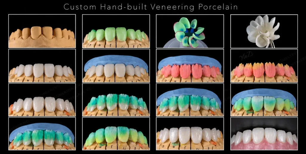 Hand-built porcelain workflow showing anterior models, layering stages and completed restorations